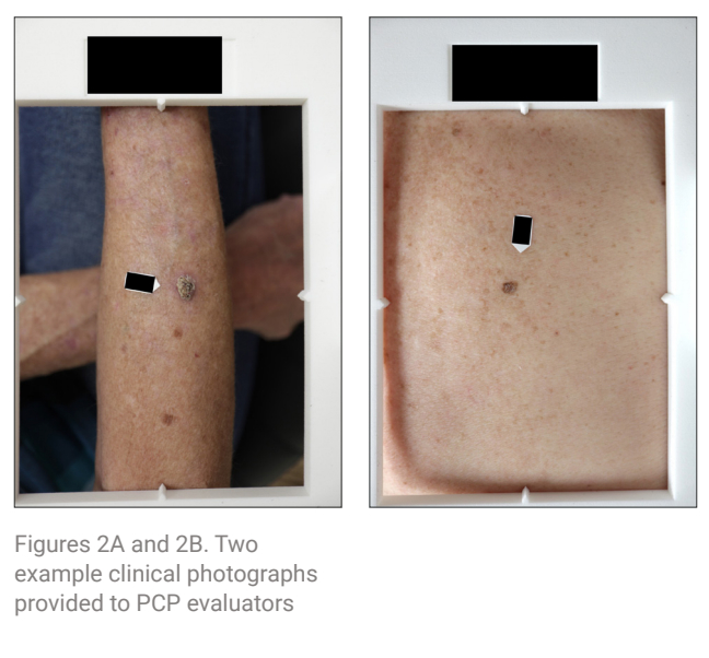 Clinical Utility of an Elastic Scattering Spectroscopy Device in Assisting Primary Care Physicians’ Detection of Skin Cancers